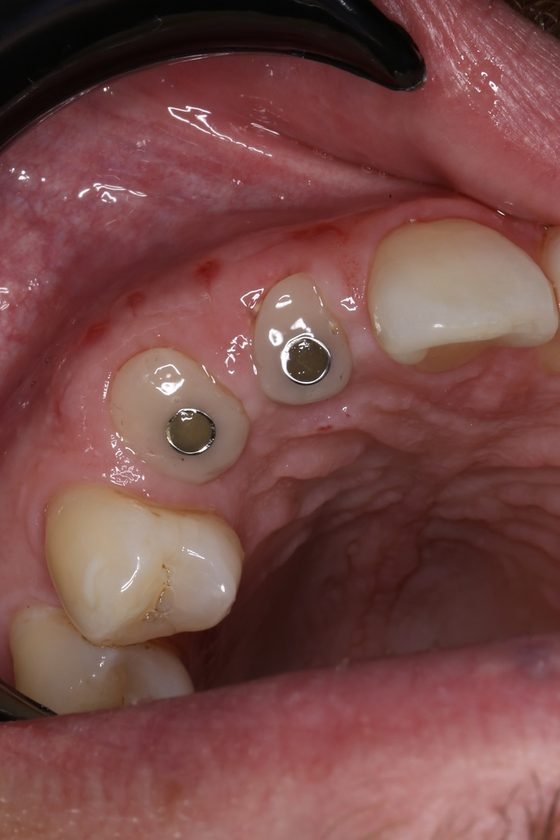Yksilölliset implanttijatkeet paikoillaan