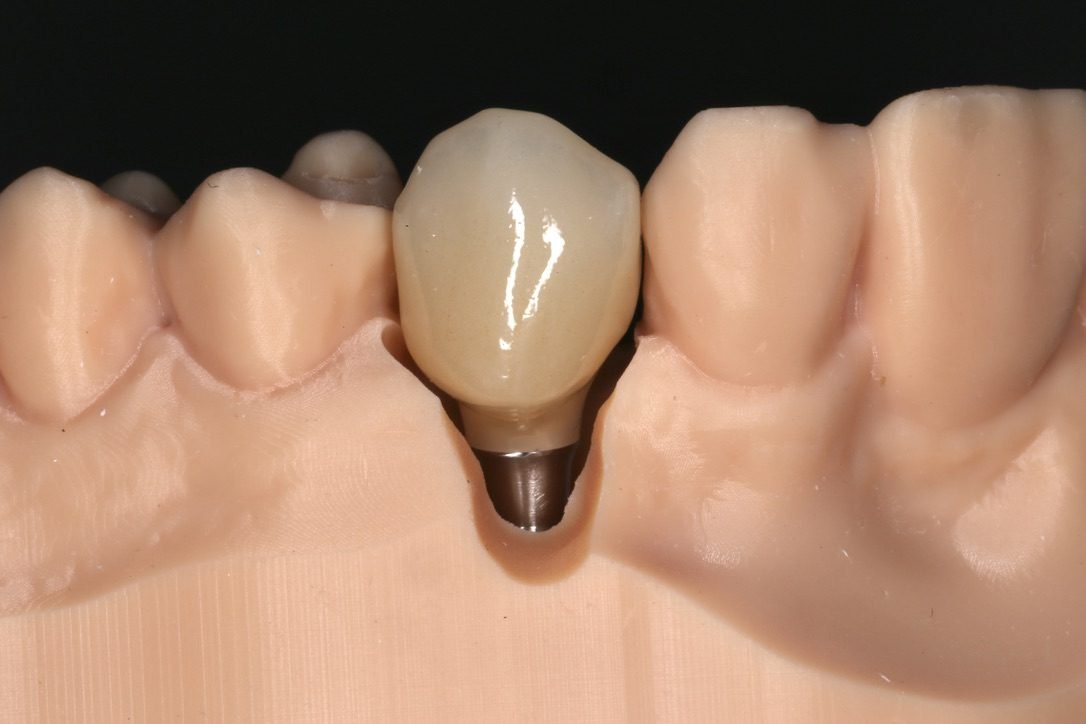 Implanttikruunu työmallilla