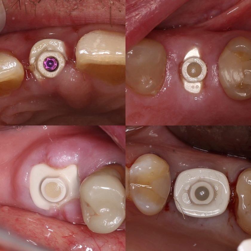 Implantin pehmytkudoksen muotoilu paranemisen eri vaiheissa